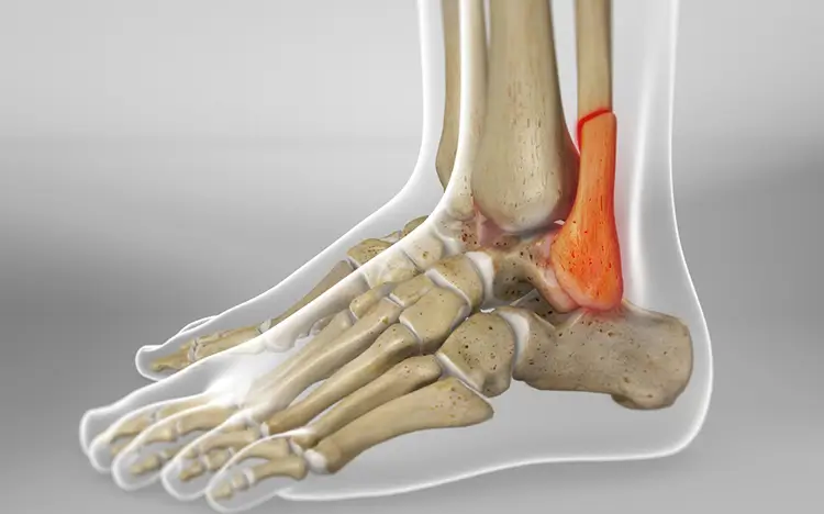 cirugia-fracturas