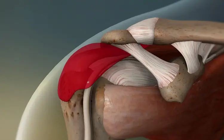bursitis