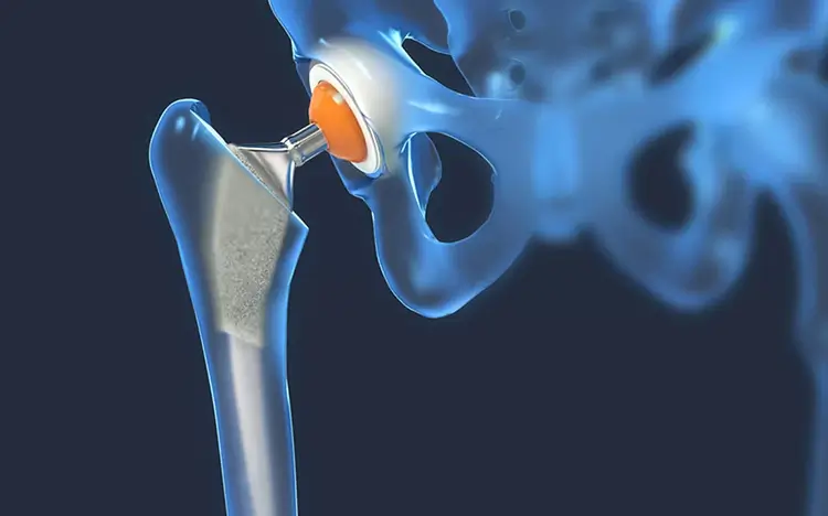 cirugia-ortopedica-cadera-rodilla