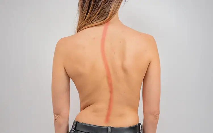 escoliosis