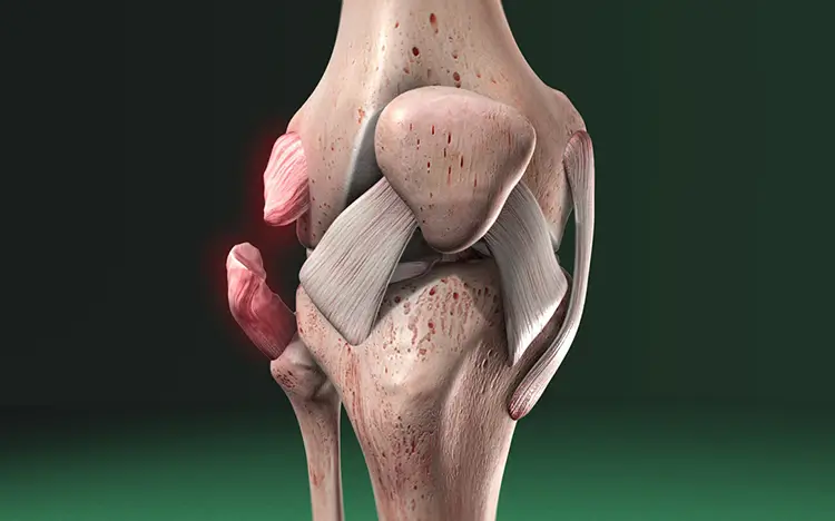 lesiones-de-ligamentos