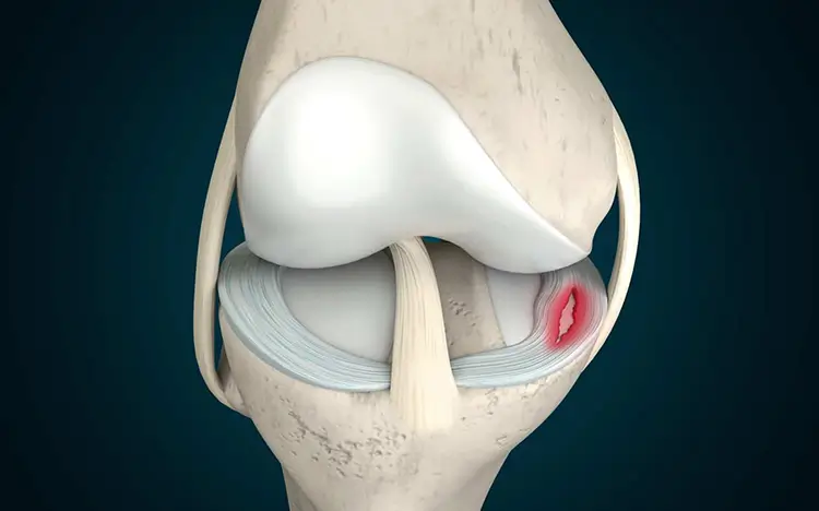 lesiones-meniscales