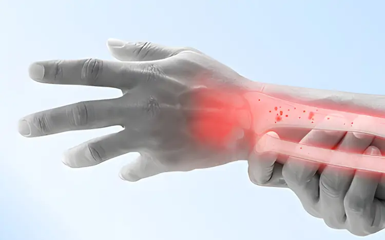 osteoporosis-fracturas-fragilidad